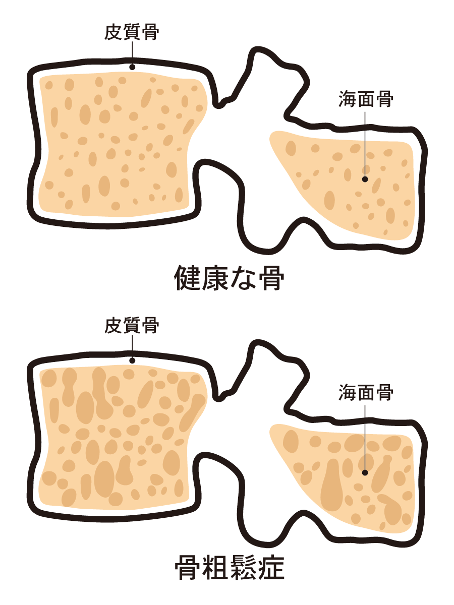 骨粗鬆症